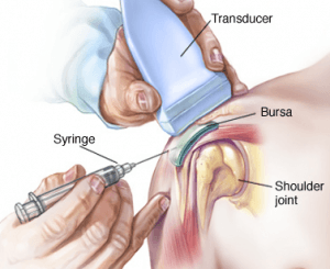 Intra articular steroid injection shoulder procedure
