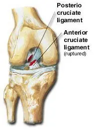 acl-injuries