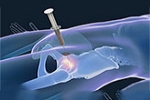 Benefits of Stem Cell Therapy for Hip Recovery