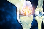 Cartilage Restoration Techniques: New Hope for Early Arthritis