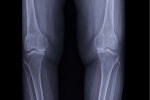 Femoral Anteversion in Adults