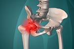 Hip Impingement Isn’t Just Bone: The Role of Soft Tissue in FAI Symptoms