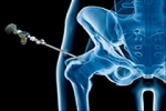 Outcomes of Hip Arthroscopy in Competitive Athletes