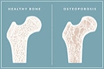 Preventing Osteoporosis
