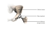 The Best Hip Replacement Materials