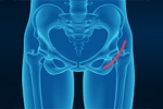The Growing Trend of Direct Anterior Hip Replacement