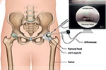 What is Hip Arthroscopy?