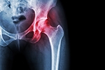Why Some Patients with Severe Arthritis Have Little Pain - While Others Struggle Early