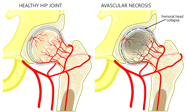 Avascular Necrosis Diagnoses