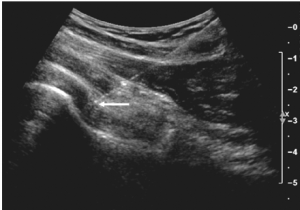 Ultrasound Guided Injections