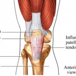 Knee Tendonitis
