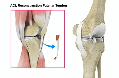 ACL Reconstruction - 1 - Educational Photo
