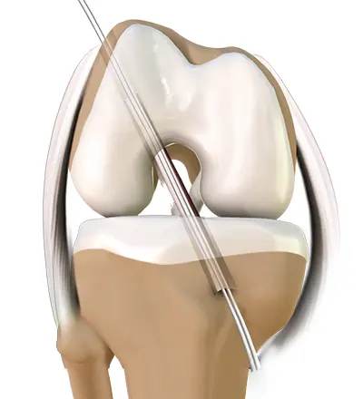 ACL Tear - 2 - Educational Photo