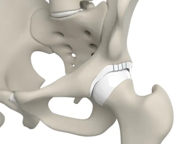 Arthroscopic Labral Repair & Reconstruction - 3 - Educational Photo