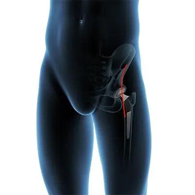 Outpatient Anterior Approach Hip Replacement