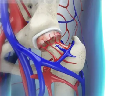 Avascular Necrosis - Benjamin Domb MD