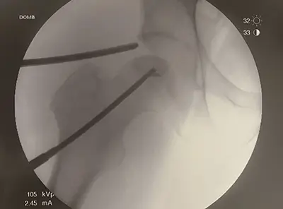 AVN Fluoro - Benjamin Domb MD