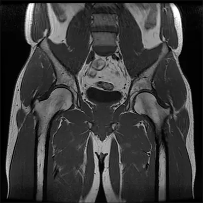 DiagnosisIT Band Syndrome