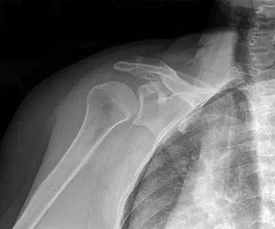 Bankart Tear Diagnosed - Benjamin Domb MD