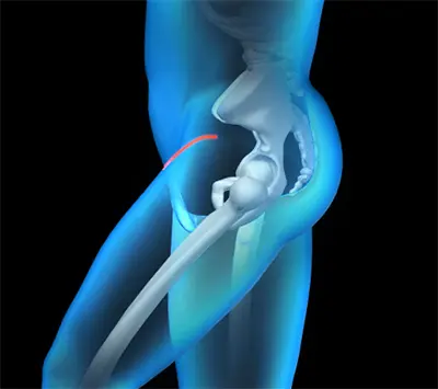 Benefits of the Bikini Incision Hip Replacement