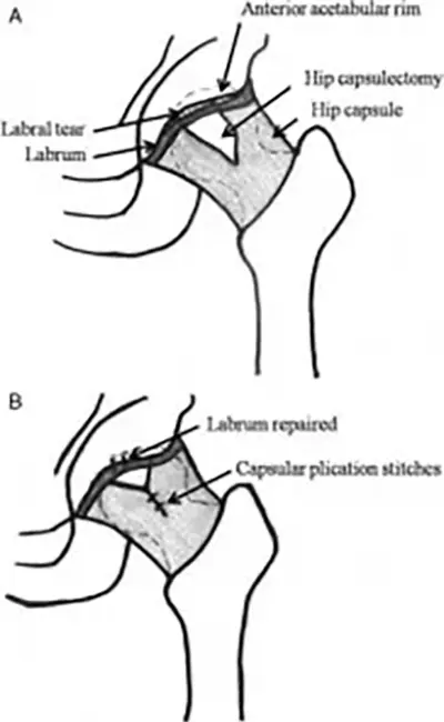 Work Hip Arthroscopy