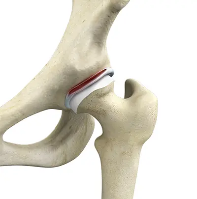 Causes Snapping Hip