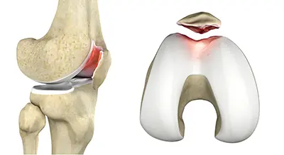 Patellar Tendinitis - 3 - Educational Photo