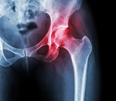 Diagnosis Hip