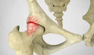 Symptoms Femoroacetabular Impingement