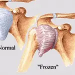 Frozen Shoulder