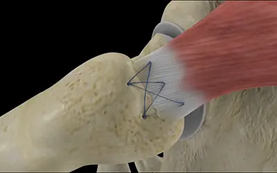 Recovery gluteus medius tear