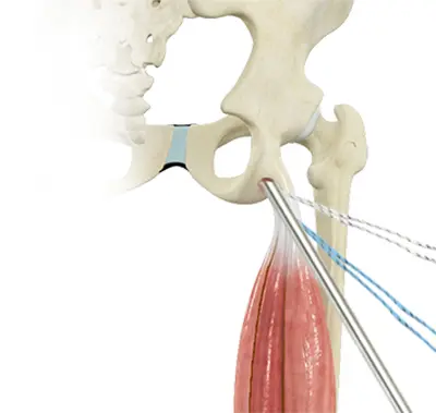 Endoscopic Hip Tendon Repair - 4 - Educational Photo