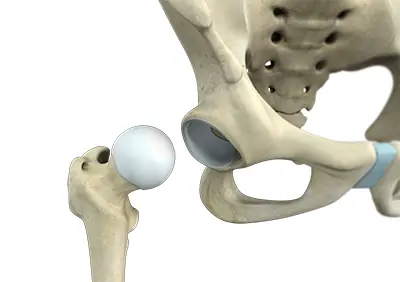 Hip Labral Tear - Benjamin Domb MD
