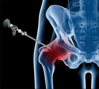 Reasons for Hip Arthroscopy - Benjamin Domb MD
