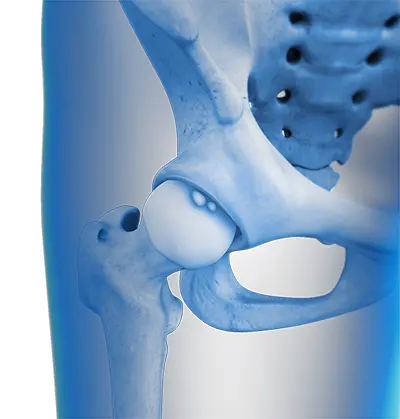 Causes Hip Loose Body