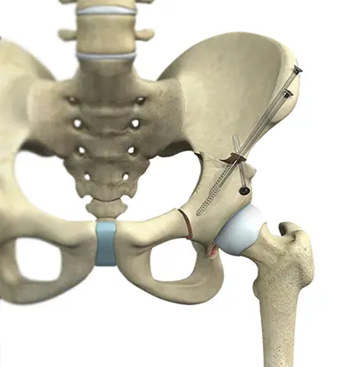 Hip Preservation Surgery - 2 - Educational Photo