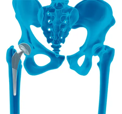 candidate Hip Replacement - Benjamin Domb MD