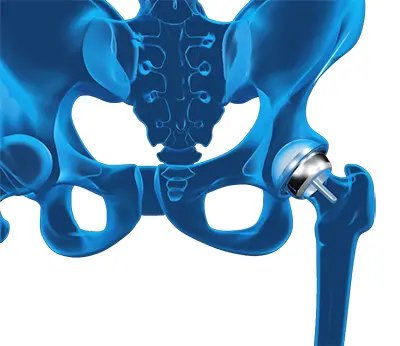 Hip resurfacing - Benjamin Domb MD