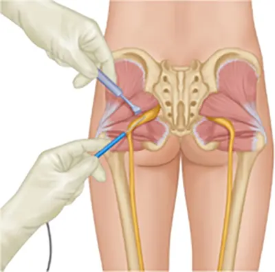 Piriformis Syndrome Surgical Treatment - Benjamin Domb MD