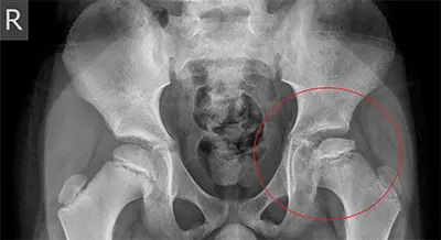 Diagnosis of Perthes Disease - Benjamin Domb MD
