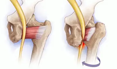 What is Ischiofemoral Impingement - Benjamin Domb MD