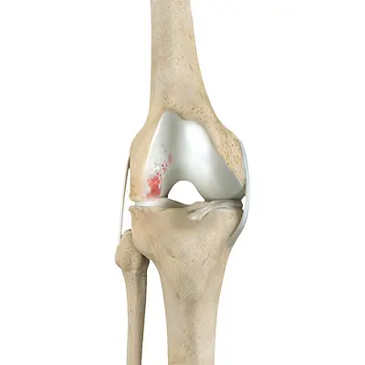 Knee Arthritis - 1 - Educational Photo