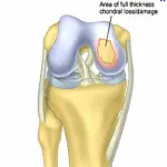 Chondral Defects