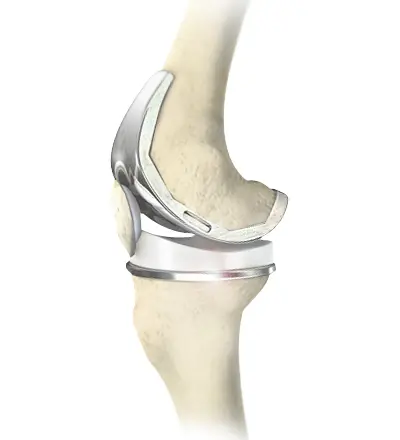 Total Knee Replacement