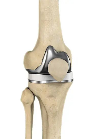 Knee Arthritis - 6 - Educational Photo
