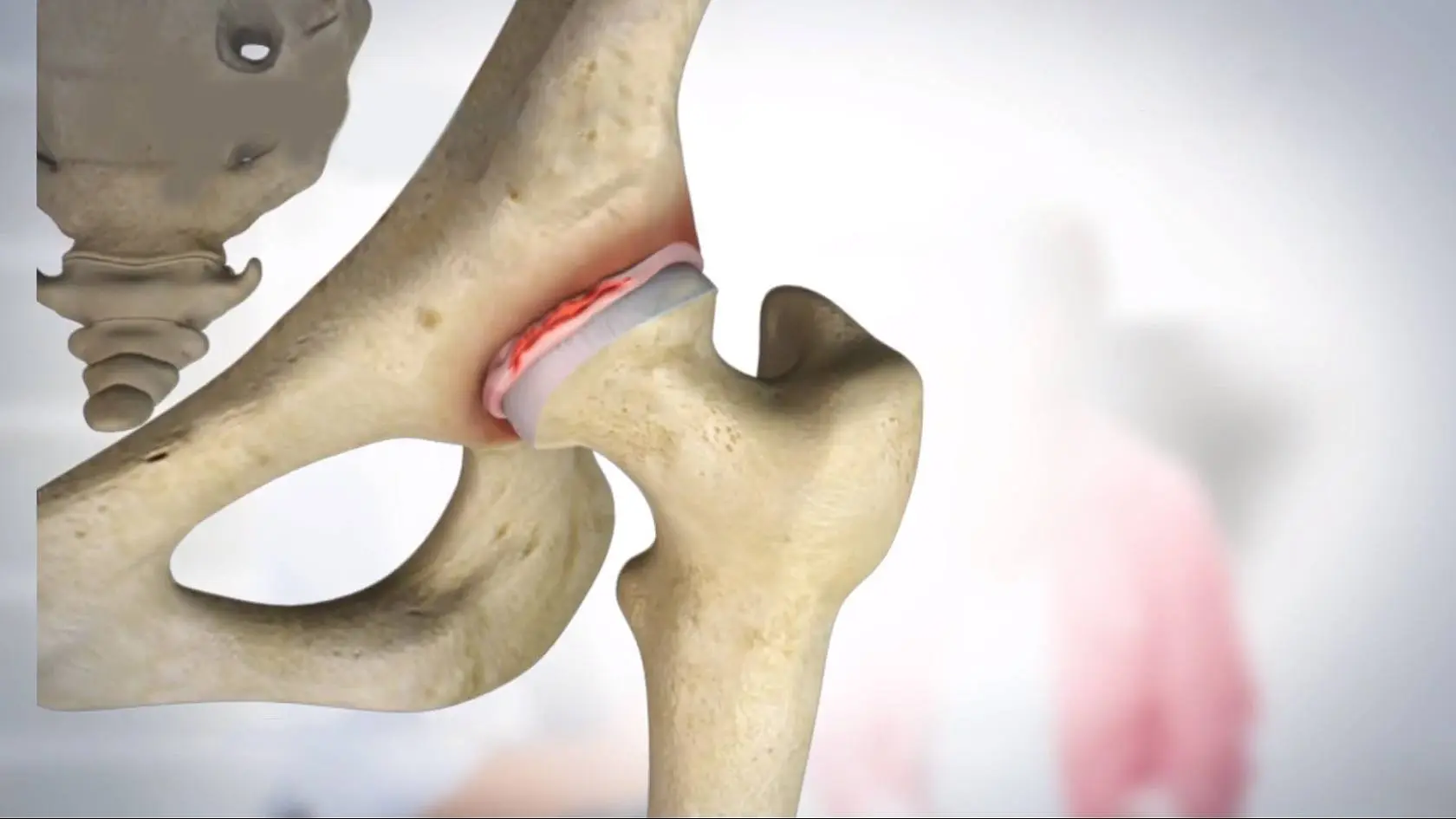 Advantages of Hip Arthroscopy - Benjamin Domb MD