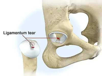 Ligamentum Teres Tears - Benjamin Domb MD
