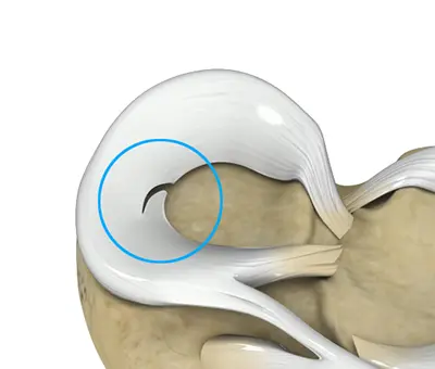 Meniscal Tears - 2 - Educational Photo