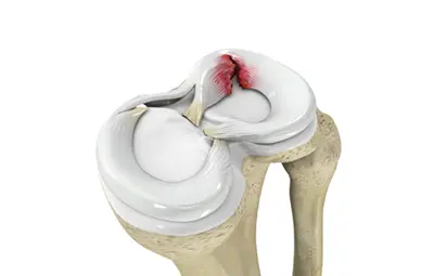 Meniscus Tear - Benjamin Domb MD