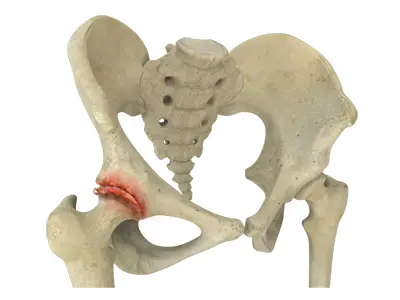 Arthritis Hip